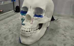 Johnson Johnson 3 D Printed Skull