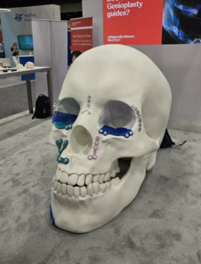 Johnson Johnson 3 D Printed Skull