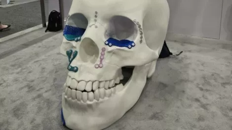 Johnson Johnson 3 D Printed Skull
