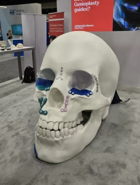 Johnson Johnson 3 D Printed Skull