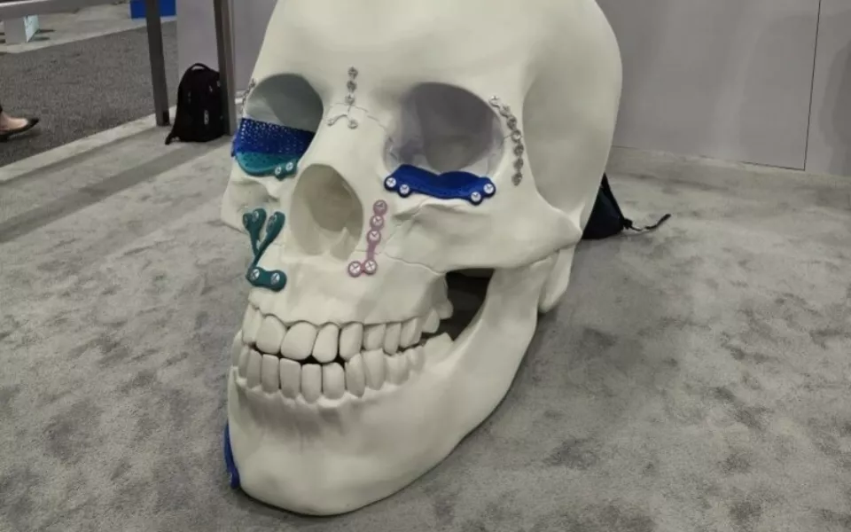 Johnson Johnson 3 D Printed Skull