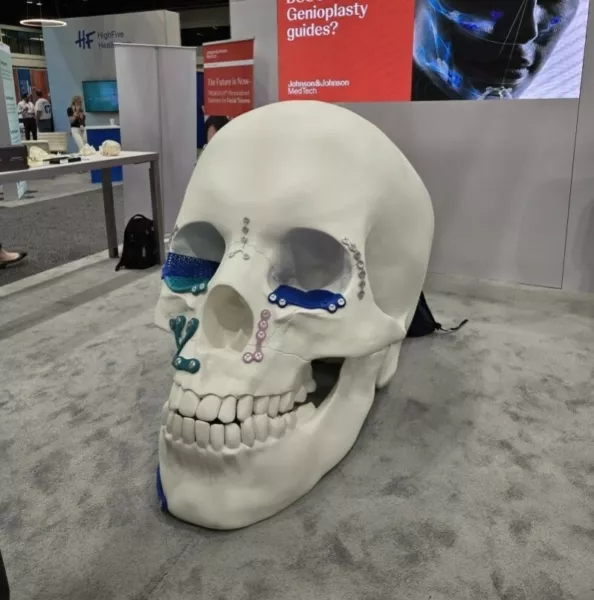 Johnson Johnson 3 D Printed Skull