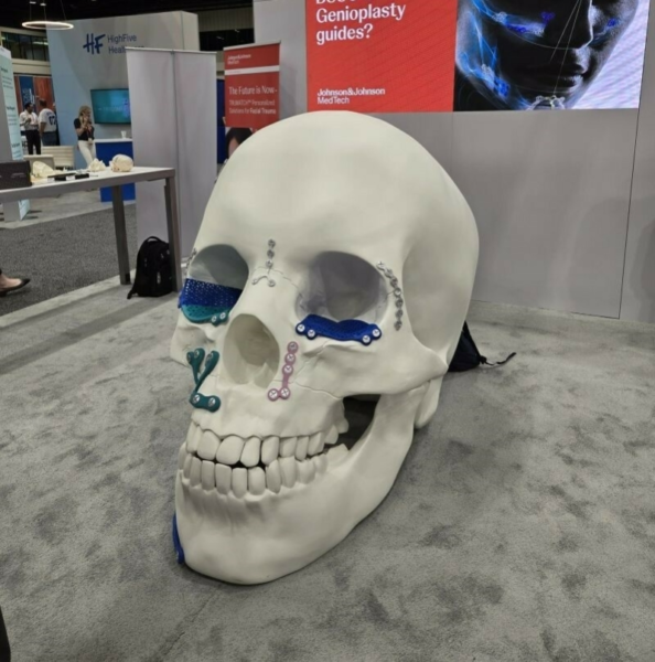 Johnson Johnson 3 D Printed Skull